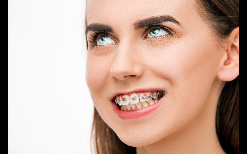 Adult Braces
