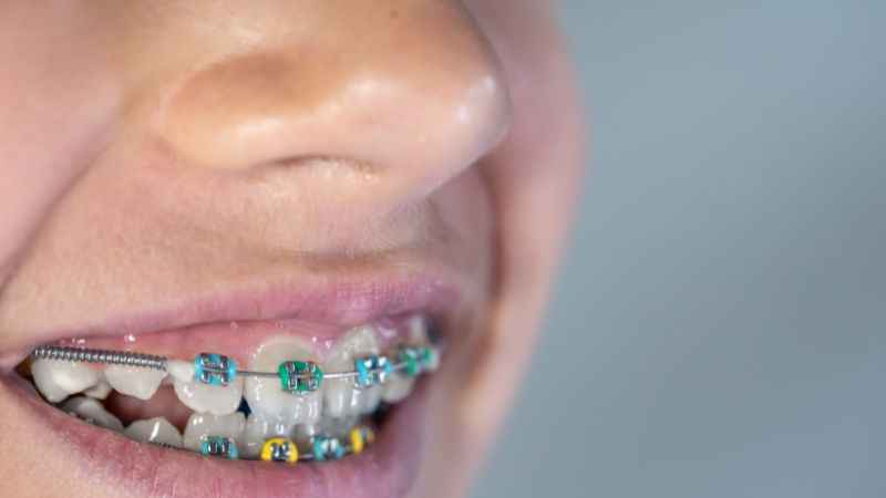 Baby blue braces