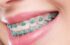 Blue Braces Colors: Exploring the Perfect Hue for Your Smile