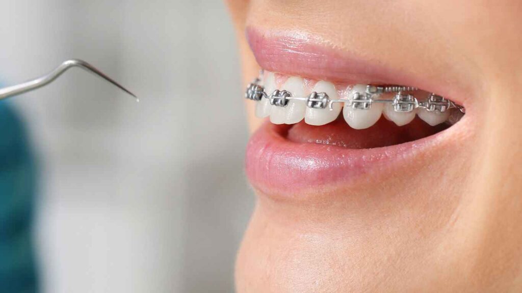 Braces Appliances roof of mouth
