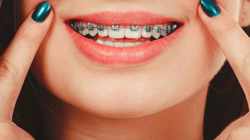 Braces Colors for Girl

