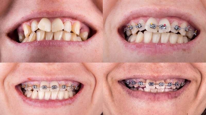 Braces Before and After 