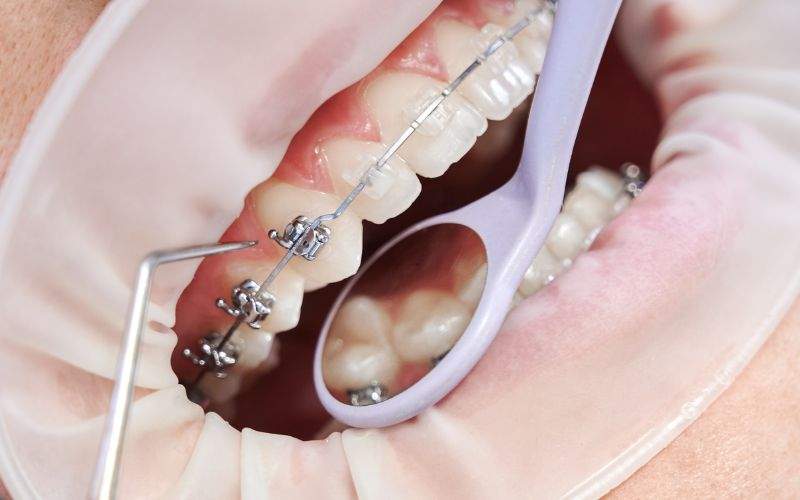 Braces for Teeth Gap