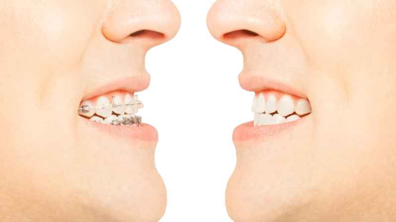 Braces On Crooked Teeth – Before And After 
