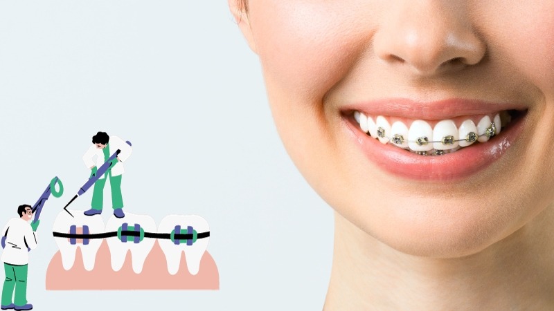 Metal Braces orthodontics 
