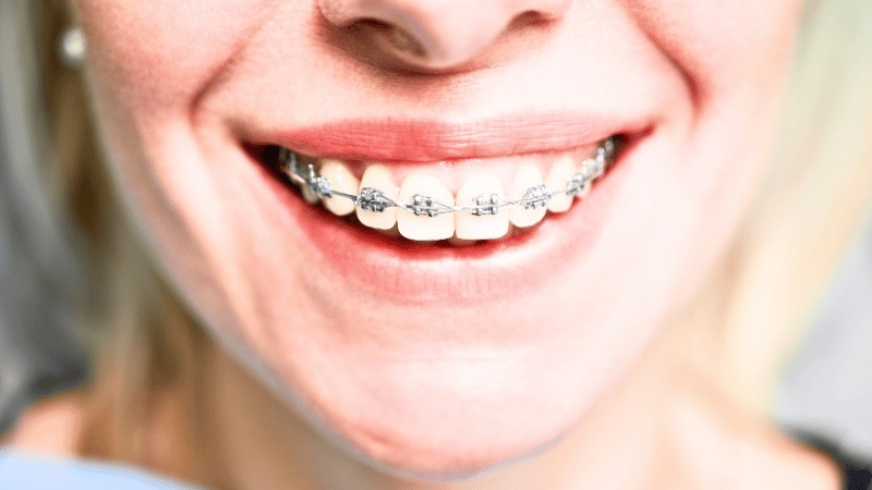 braces colors with white teeth